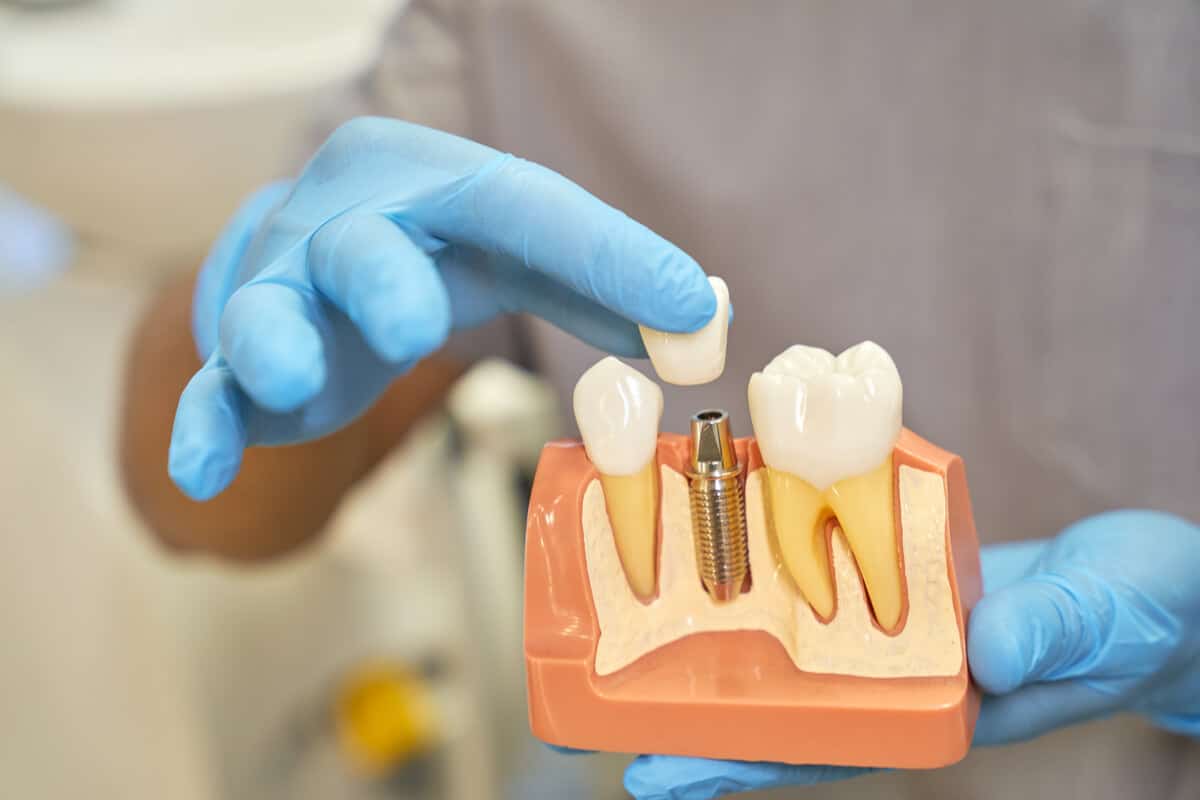Understanding Dental Implants – How they Work and Why They Might Suit You