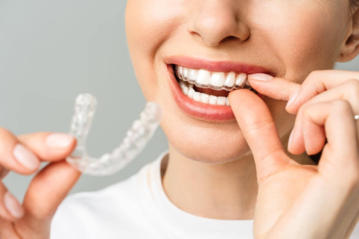 Top 9 Benefits of Invisalign Treatment